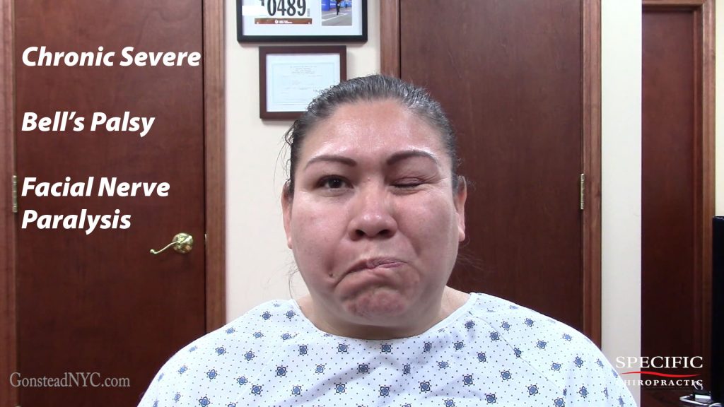 Chronic Severe Bells Palsy Facial Nerve Paralysis Helped By Dr Suh My