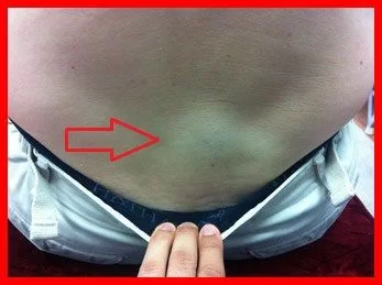 Structural Correction Manhattan 2 Edema due to herniated disc