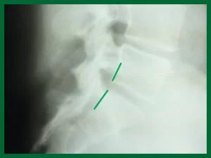 Structural Correction Manhattan 7 After X-ray