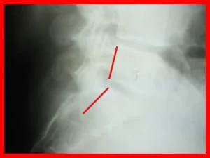 Structural Correction Manhattan 6 Before X-ray
