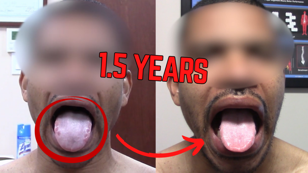 Before and after comparison of a swollen tongue with ridges showing reduced swelling and smoother edges after treatment