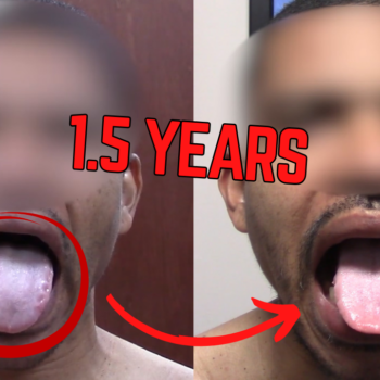 Emotional Relief from Carpal Tunnel - Hand Strength Restored Without Surgery 2 Before and after comparison of a swollen tongue with ridges showing reduced swelling and smoother edges after treatment