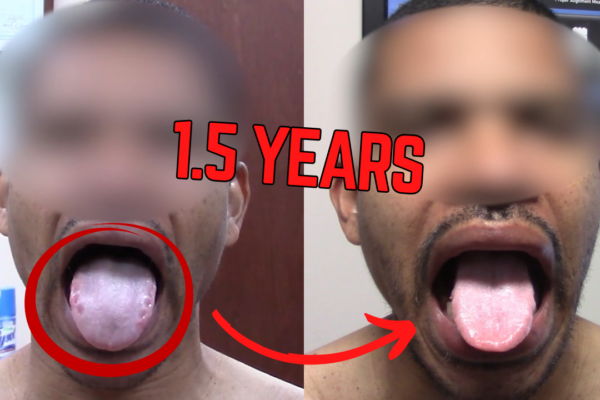 Before and after comparison of a swollen tongue with ridges showing reduced swelling and smoother edges after treatment
