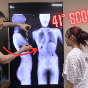 13 Year Old with 41° Scoliosis Since Birth — 80% Mid Back Pain Relief After ONE Adjustment 1 13 year old with 41 degree Cobb angle scoliosis receiving Gonstead chiropractic adjustment for mid back pain after pelvic misalignment
