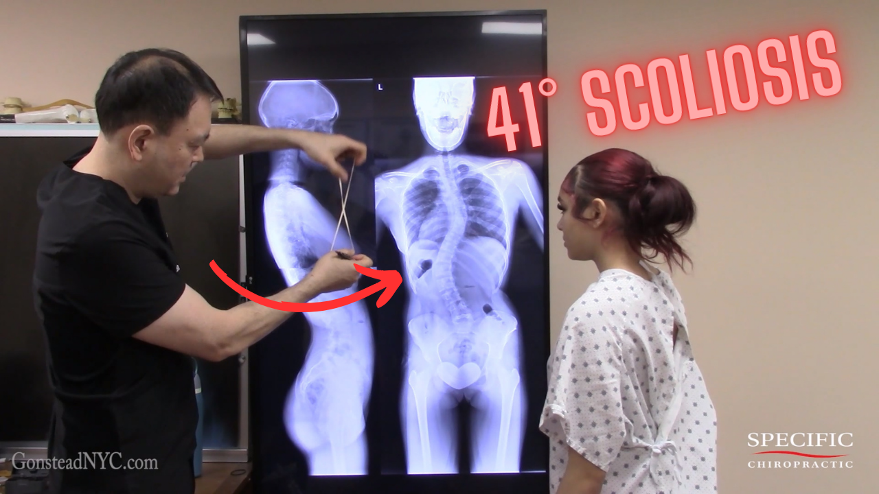 13 Year Old with 41° Scoliosis Since Birth — 80% Mid Back Pain Relief After ONE Adjustment 1 13 year old with 41 degree Cobb angle scoliosis receiving Gonstead chiropractic adjustment for mid back pain after pelvic misalignment